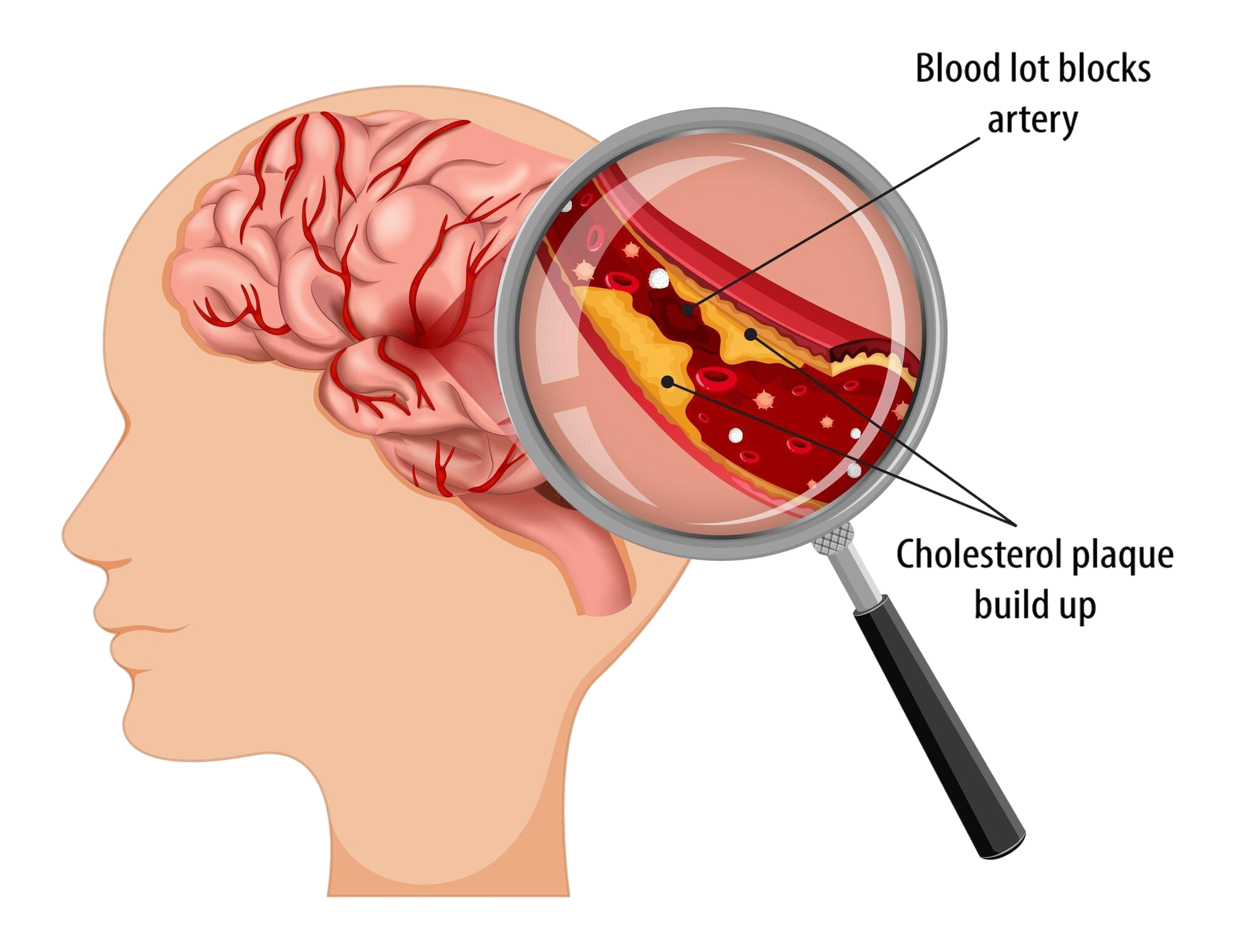 Stroke Diagram